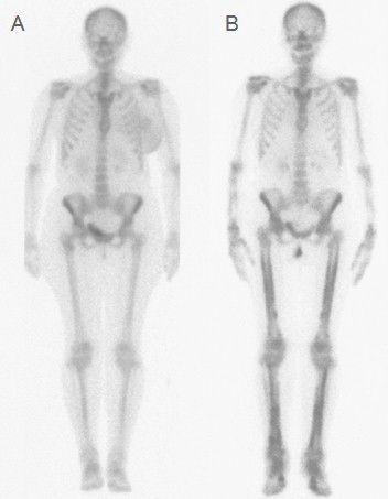 osteoartropatia_hipertrofica_paraneoplasica/gammagrafia_osea_completa