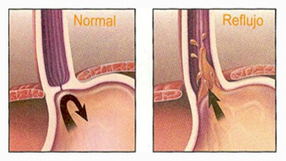 _revision_hernia_hiatal/anatomia_patologica_concepto