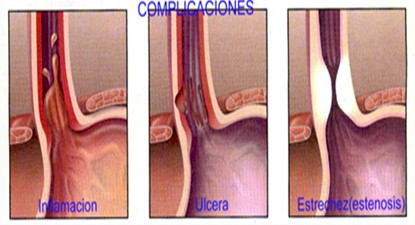 revision_hernia_hiatal/complicaciones_hernia_hiato