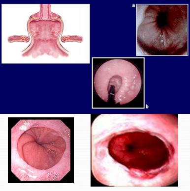 revision_hernia_hiatal/endoscopia_tipo_deslizamiento