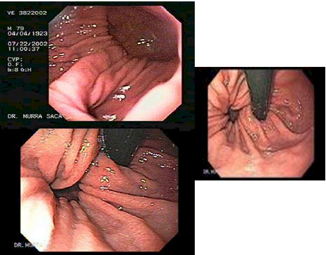 revision_hernia_hiatal/endoscopia_tipo_paraesofagica