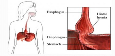 revision_hernia_hiatal/esquema_concepto_hiato