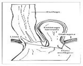 revision_hernia_hiatal/tipo_II_paraesofagica