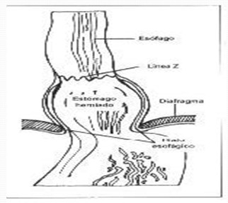 revision_hernia_hiatal/tipo_I_deslizamiento