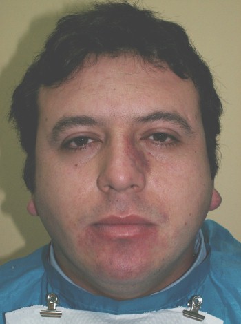sindrome_sturge_weber/SSW_caso_clinico sindrome_sturge_weber/SSW_caso_clinico