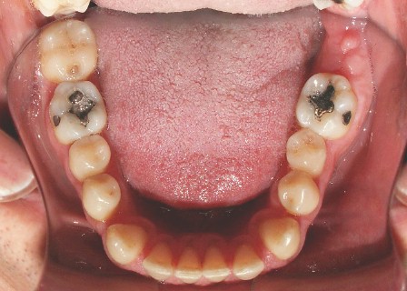 sindrome_sturge_weber/caries_hiperplasia_gingival