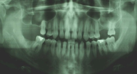 sindrome_sturge_weber/destruccion_hueso_alveolar