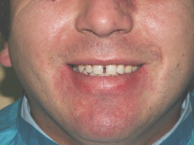 sindrome_sturge_weber/diastema_interincisivo sindrome_sturge_weber/diastema_interincisivo