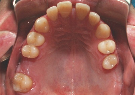 sindrome_sturge_weber/hiperplasia_gingival