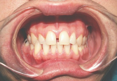 sindrome_sturge_weber/hiperplasia_gingival_leve