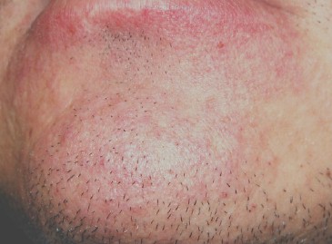 sindrome_sturge_weber/nevus_flammeus