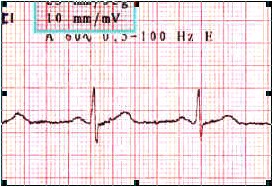 ECG_electrocardiografia_basica/componentes_ecg_normal