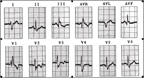 ECG_electrocardiografia_basica/ecg_eje_derecho