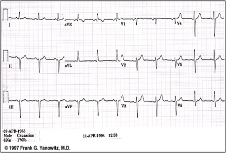 ECG_electrocardiografia_basica/ecg_eje_izquierdo