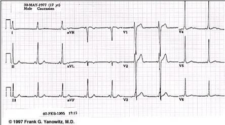 ECG_electrocardiografia_basica/ecg_eje_normal