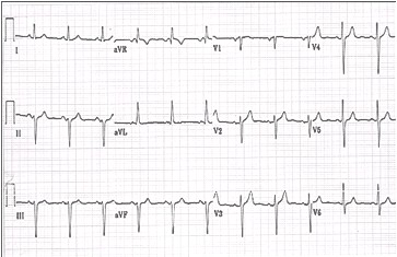 ECG_electrocardiografia_basica/ecg_posicion_horizontal