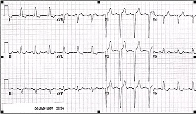 ECG_electrocardiografia_basica/ecg_posicion_semihorizontal