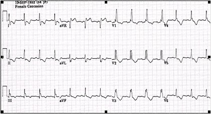 ECG_electrocardiografia_basica/ecg_posicion_semivertical