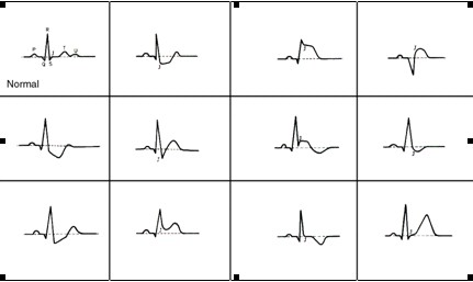 ECG_electrocardiografia_basica/el_punto_j