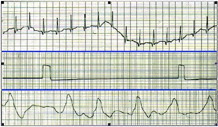 ECG_electrocardiografia_basica/electrocardiograma_calidad_registro