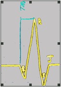 ECG_electrocardiografia_basica/examen_del_qrs