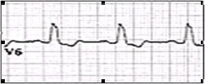 ECG_electrocardiografia_basica/examen_onda_t