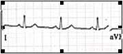 ECG_electrocardiografia_basica/grafico_ritmo_sinusal