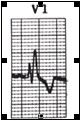 ECG_electrocardiografia_basica/onda_r_v1