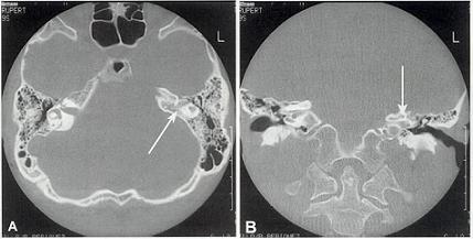 TAC_patologia_auditiva/ausencia_oido_interno