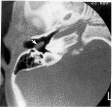 TAC_patologia_auditiva/colesteatoma_congenito TAC_patologia_auditiva/colesteatoma_congenito