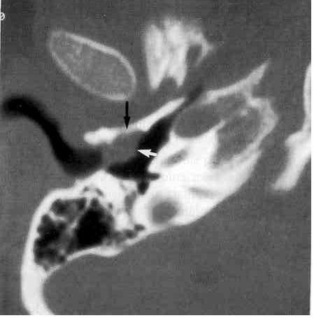 TAC_patologia_auditiva/colesteatoma_timpanoplastia TAC_patologia_auditiva/colesteatoma_timpanoplastia