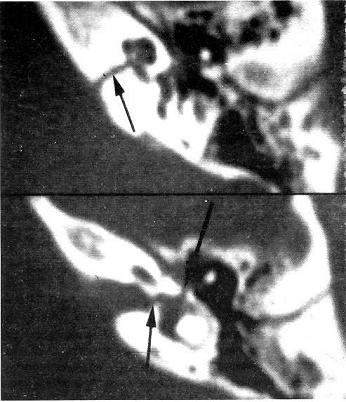 TAC_patologia_auditiva/fractura_vestíbulo_coclear