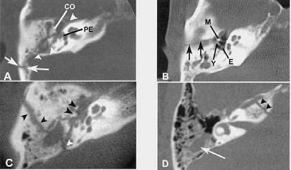 TAC_patologia_auditiva/fracturas_laberinticas