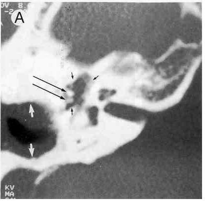 TAC_patologia_auditiva/otitis_externa