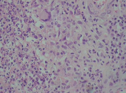 TBC_tuberculosis_orbitaria/microscopia_anatomia_patologica TBC_tuberculosis_orbitaria/microscopia_anatomia_patologica