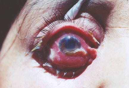 ocular tuberculosis