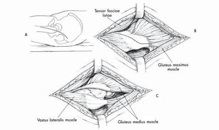 abordaje_artroplastia_cadera/artroplastia_Hardinge