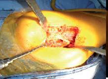 abordaje_artroplastia_cadera/canal_femoral_2