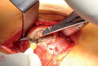 abordaje_artroplastia_cadera/diseccion_tendon