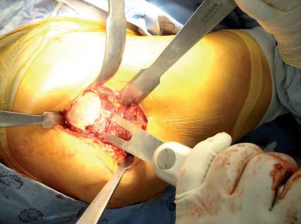 abordaje_artroplastia_cadera/exeresis_cabeza_femoral abordaje_artroplastia_cadera/exeresis_cabeza_femoral
