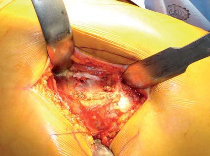 abordaje_artroplastia_cadera/incision_L_2 abordaje_artroplastia_cadera/incision_L_2