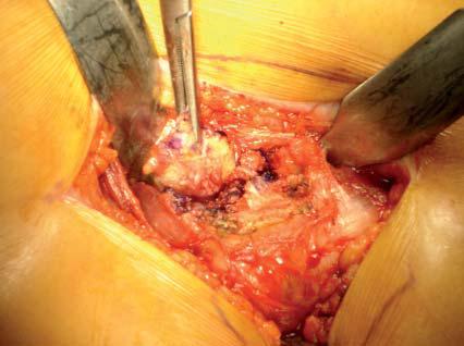 abordaje_artroplastia_cadera/incision_L_3 abordaje_artroplastia_cadera/incision_L_3