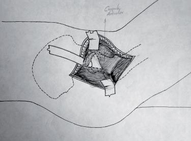 abordaje_artroplastia_cadera/incision_capsular_L