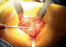 abordaje_artroplastia_cadera/preparacion_canal_femoral abordaje_artroplastia_cadera/preparacion_canal_femoral