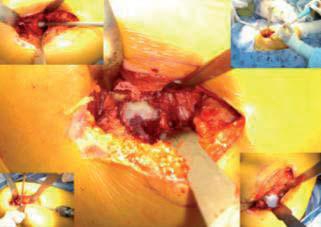 abordaje_artroplastia_cadera/preparacion_componente_acetabular abordaje_artroplastia_cadera/preparacion_componente_acetabular