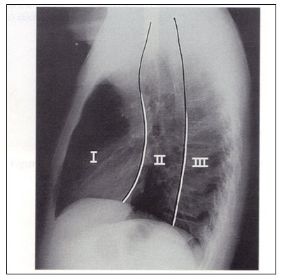 anatomia_mediastino_mediastinica/mediastino_compartimientos_radiografia