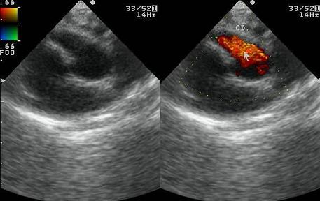 arteria_coronaria_derecha/ecocardio_cd arteria_coronaria_derecha/ecocardio_cd