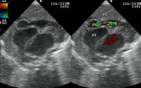 arteria_coronaria_derecha/ecocardio_fistula1