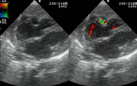 arteria_coronaria_derecha/ecocardio_fistula2