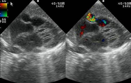 arteria_coronaria_derecha/ecocardio_fistula3